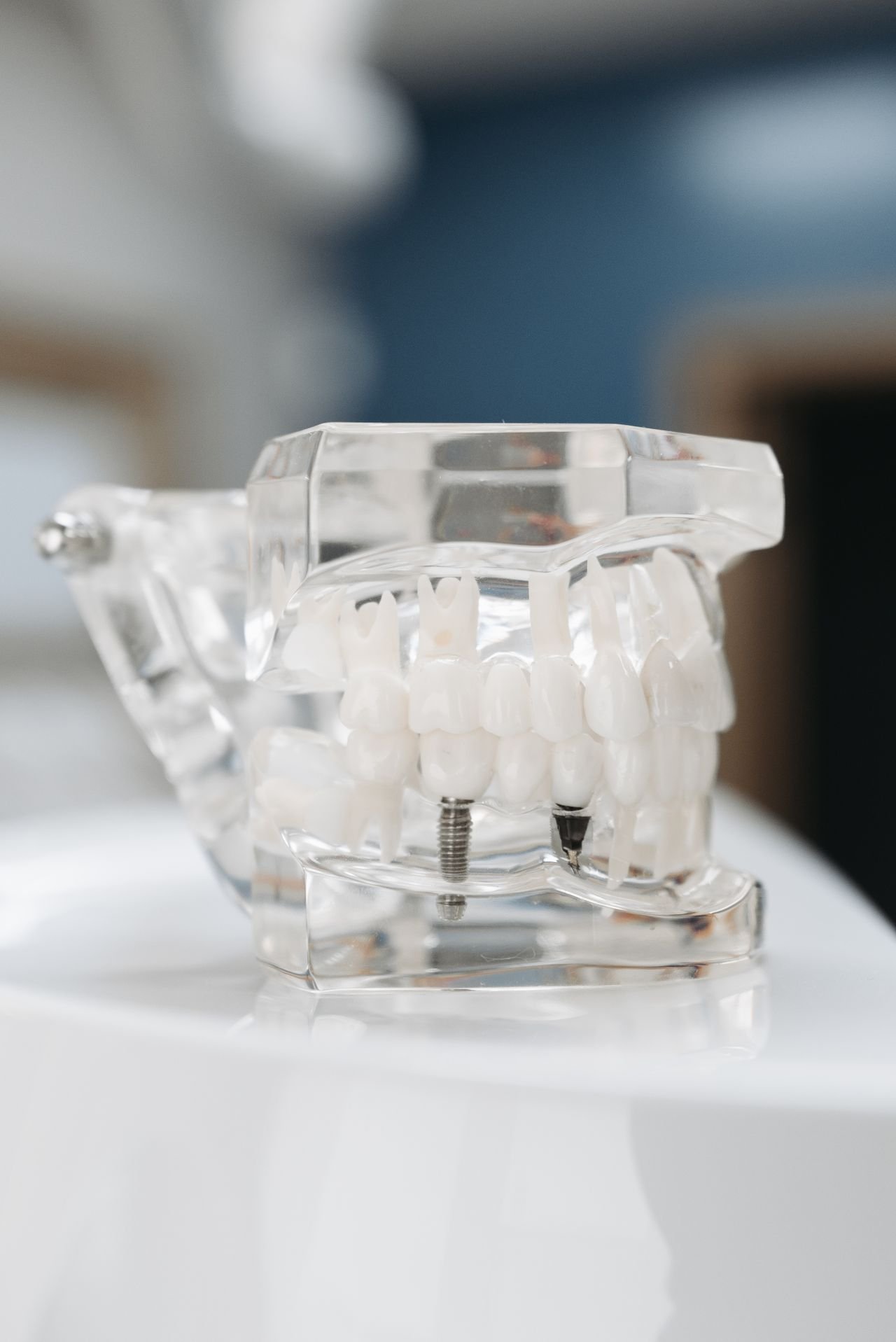 Transparent dental implant model on display