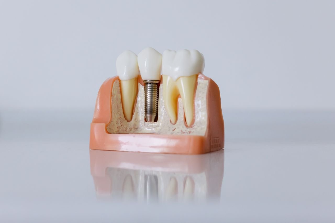 Close-up of a dental implant model